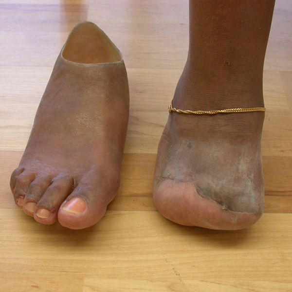 Feet Archives - Aesthetic Prosthetics Inc®