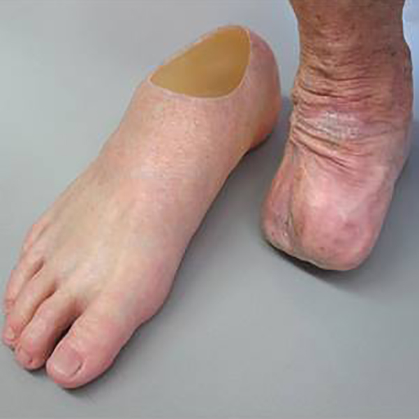 Feet Archives - Aesthetic Prosthetics Inc®